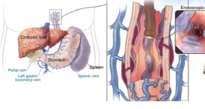 Liver Disease