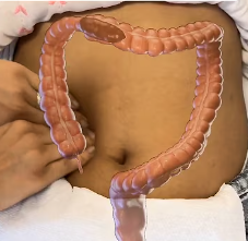 Bloating
