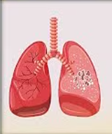 Tuberculosis