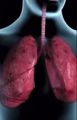 Tuberculosis