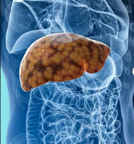 Fatty Liver