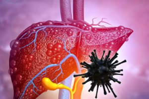 Hepatitis