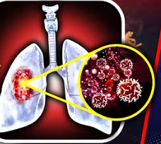 Lung Cancer