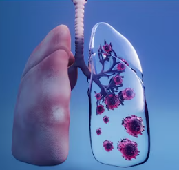 Lung Cancer